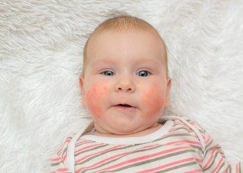 Allergiás a babám?